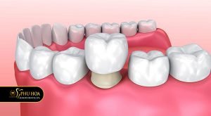 boc-rang-su-co-dau-khong