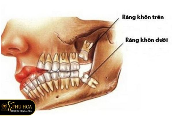 rang-khon-co-may-cai-may-chan-rang-khon-moc-ngam