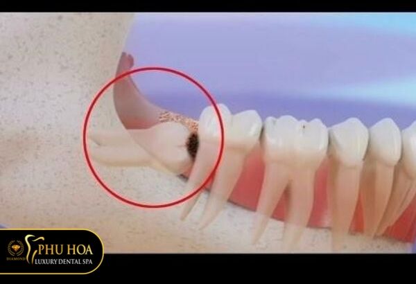 hinh-anh-rang-khon-moc-lech-rang-so-7