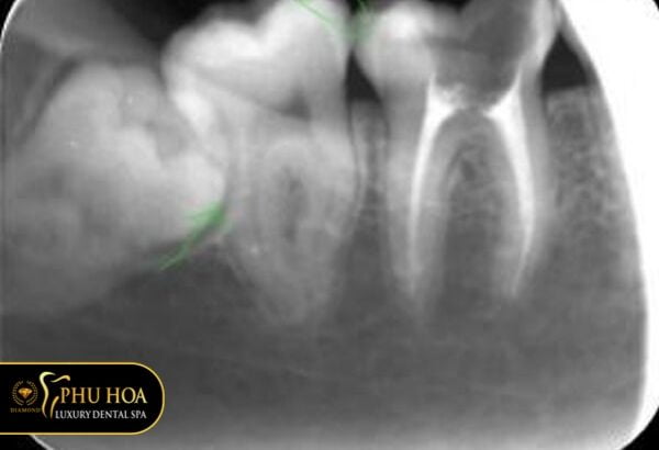 hinh-anh-rang-khon-moc-lech-ngam