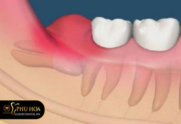 hinh-anh-rang-khon-moc-sung-nuou