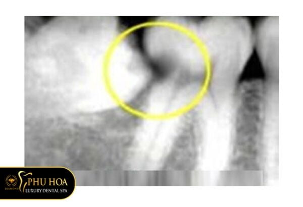 rang-khon-gay-sau-rang-ke-ben