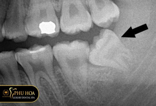 rang-khon-moc-hoi-lech