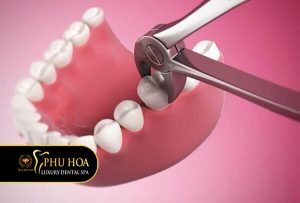 nhỏ-rang-can-chuan-bi-gi