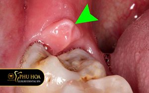 rang-khon-sung-dau-nen-lam-gi