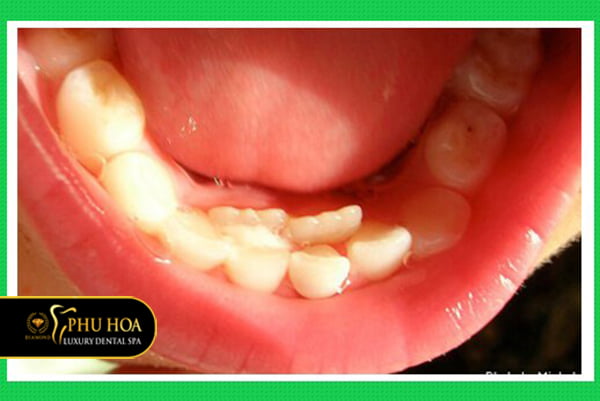 tuoi-moc-va-thay-rang-sua