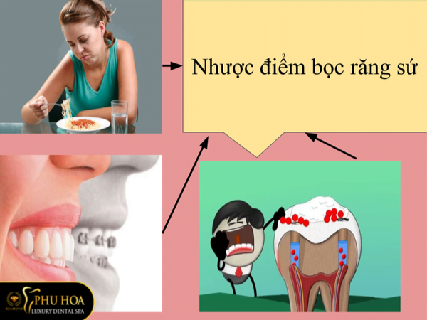 uu-nhuoc-diem-cua-boc-rang-su-nhuoc-diem