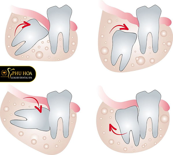 vi-tri-moc-rang-khon