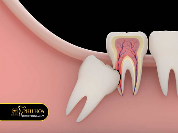 nhung-luu-y-khi-nho-rang