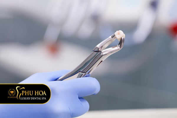 nhung-luu-y-khi-nho-rang