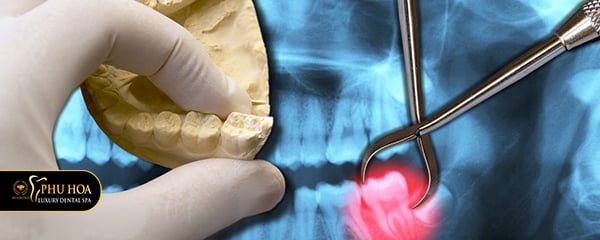 nhung-luu-y-khi-nho-rang