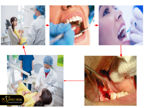 quy-trinh-nho-rang-khon-phu-hoa