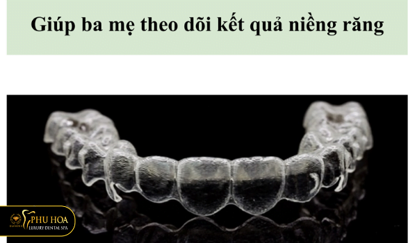 su-that-ve-nieng-rang-invisalign-cho-tre