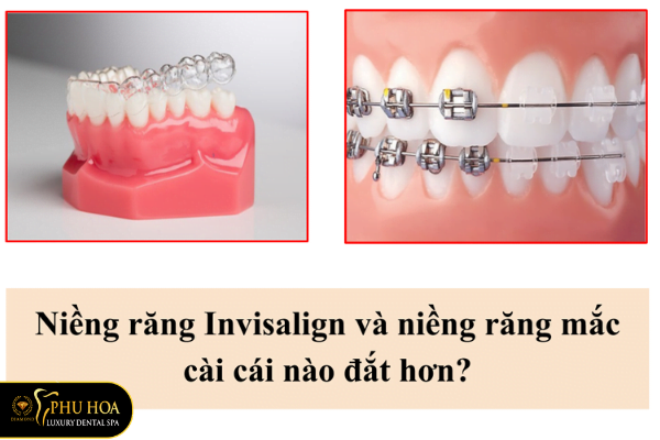 so-sanh-chi-phi-nieng-rang-invisalign