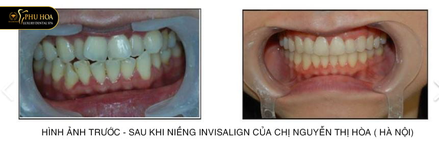nieng-rang-invisalign-o-dau-tot