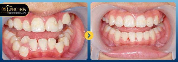 nieng-rang-invisalign-o-dau-tot