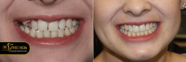 nieng-rang-invisalign-o-dau-tot