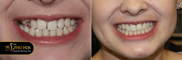 review-nieng-rang-invisalign