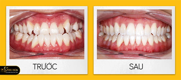 review-nieng-rang-invisalign