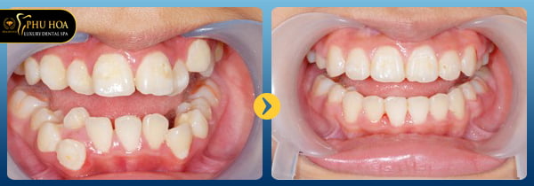 review-nieng-rang-invisalign