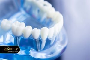 chi-phi-trong-rang-implant-toan-ham