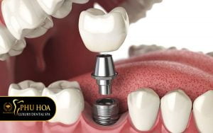 trong-rang-implant-co-nguy-hiem-khong