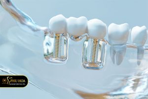 trong-rang-implant-o-dau-tot