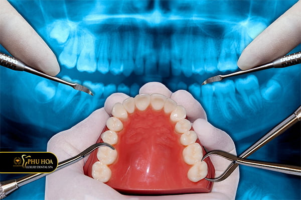 quy-trinh-nho-rang-khon-an-toan-tieu-chuan-2