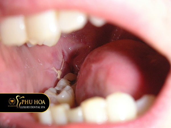 quy-trinh-nho-rang-khon-an-toan-tieu-chuan-3