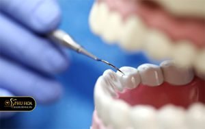 rang-cam-la-gi-nho-rang-cam-co-anh-huong-gi-khong-4