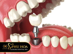 trong-rang-su-gia-bao-nhieu-trong-rang-su-vinh-vien-bao-nhieu-1-cai