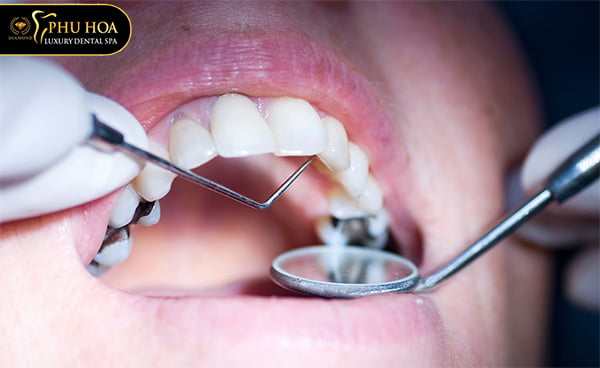 chi-phi-tram-rang-sau-bao-nhieu-tien-bang-gia-tram-rang-tai-nha-khoa