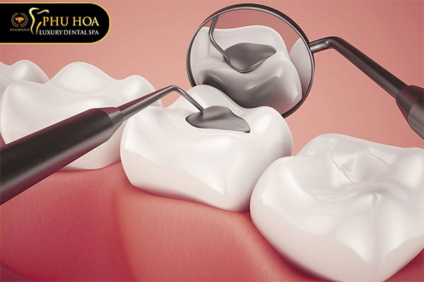 chi-phi-tram-rang-sau-bao-nhieu-tien-bang-gia-tram-rang-tai-nha-khoa