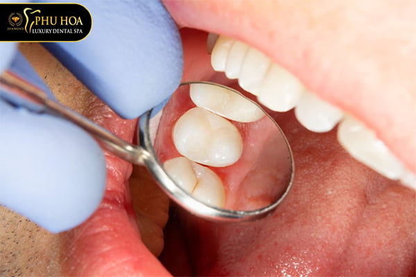 chi-phi-tram-rang-sau-bao-nhieu-tien-bang-gia-tram-rang-tai-nha-khoa