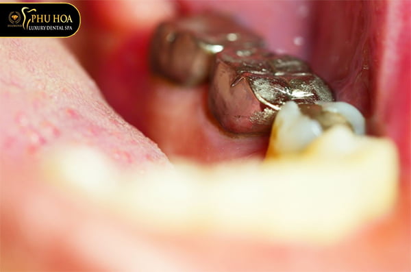 chi-phi-tram-rang-sau-bao-nhieu-tien-bang-gia-tram-rang-tai-nha-khoa