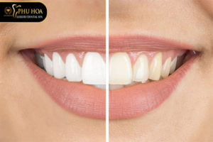 chi-phi-tram-rang-sau-bao-nhieu-tien-bang-gia-tram-rang-tai-nha-khoa