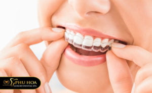 nieng-rang-bao-lau-la-on-thoi-gian-deo-nieng-chuan-nhat-tai-nha-khoa