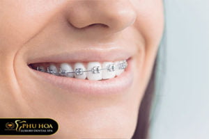 nieng-rang-ho-vau-co-nen-khong