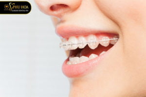 nieng-rang-mac-cai-su-la-gi-cac-loai-quy-trinh-va-thoi-gian-deo