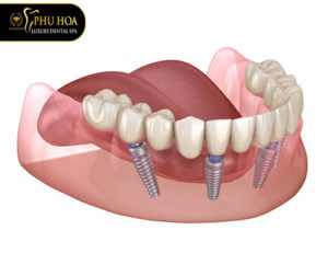 trong-rang-implant-4s-o-nha-khoa-va-nhung-dieu-ban-can-biet