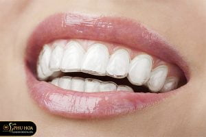 niềng răng trong suốt clear aligner