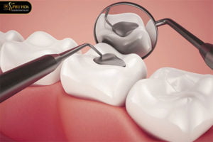 cac-muc-do-rang-sau-dien-bien-rang-sau-cu-the-cho-cach-dieu-tri-dung