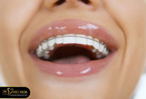 ham-duy-tri-sau-nieng-rang-la-gi-tai-sao-phai-deo-ham-duy-tri