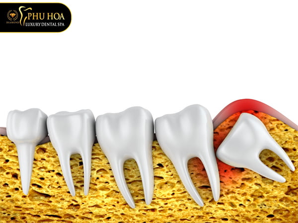 nguyen-nhan-bieu-hien-va-cach-dieu-tri-khi-moc-rang-khon-sung-mu