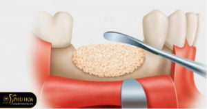 nhung-dau-hieu-nhiem-trung-sau-khi-nho-rang-khon-khong-duoc-chu-quan