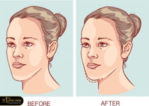 nieng-rang-co-het-mom-khong-loi-giai-dap-chuan-tu-chuyen-gia-nha-khoa