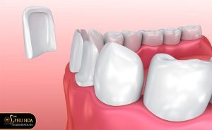 niềng răng cửa bị thưa