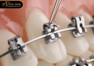 nieng-rang-mac-cai-kim-loai-tu-buoc-la-gi-co-nen-deo-hay-khong