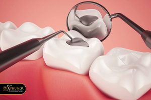quy trình trám răng sâu đạt tiêu chuẩn