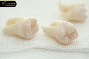 rang-cam-co-nen-nho-khong-nho-rang-cam-co-anh-huong-nguy-hiem-gi